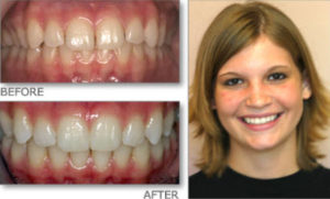 Before and after alignment and whitening at Gateway Family Dentistry