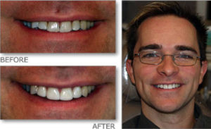 Before and after full arch restoration at Gateway Family Dentistry