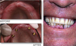 Before and after implant-supported upper at Gateway Family Dentistry