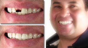 Before and after single dental implant at Gateway Family Dentistry