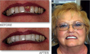 Before and after upper restoration at Gateway Family Dentistry