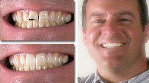 Before and after whitening and bonding at Gateway Family Dentistry