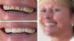 Before and after whitening and porcelain veneers at Gateway Family Dentistry
