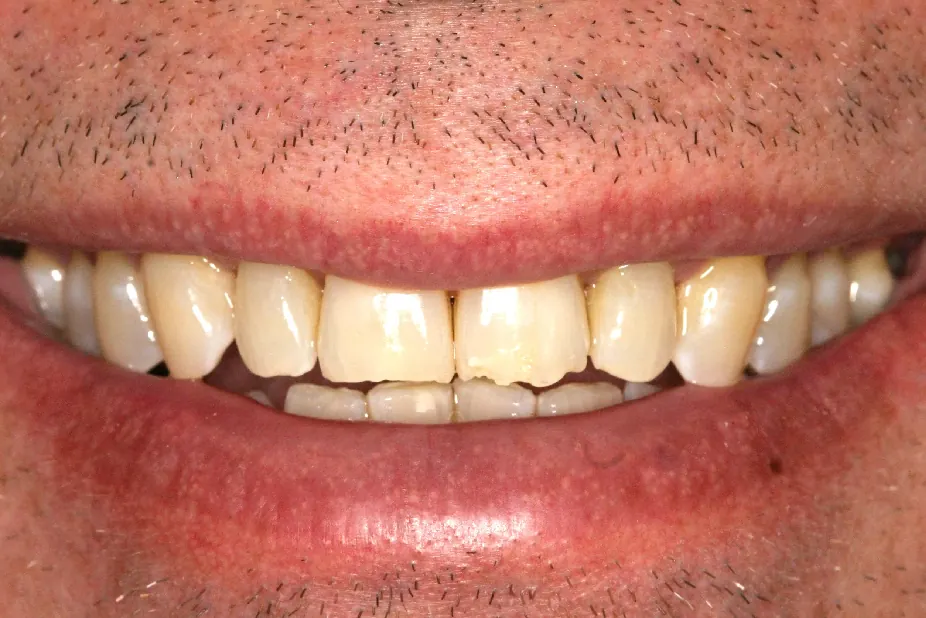 Before: chipped teeth