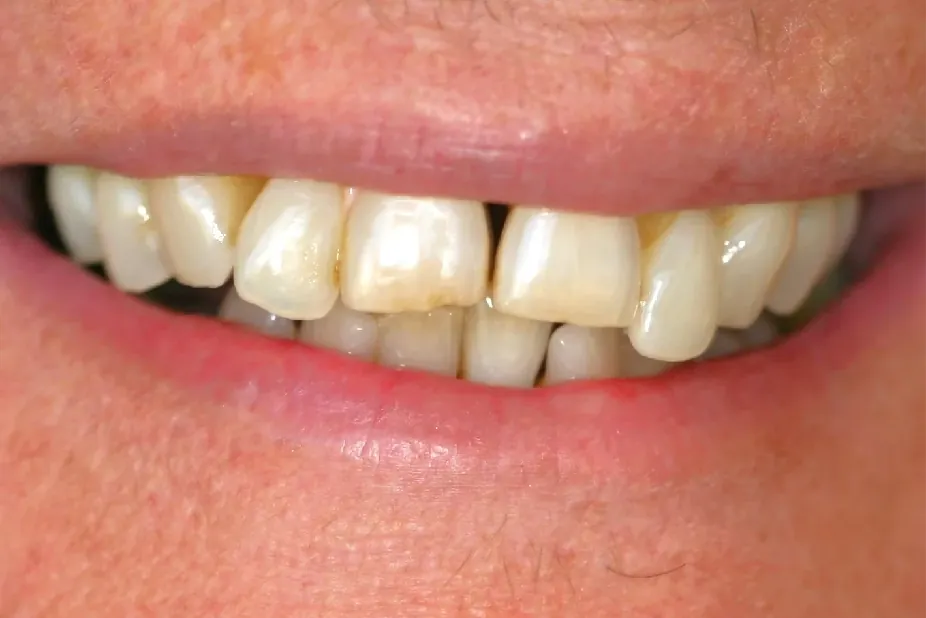 Before: crooked teeth with discoloration