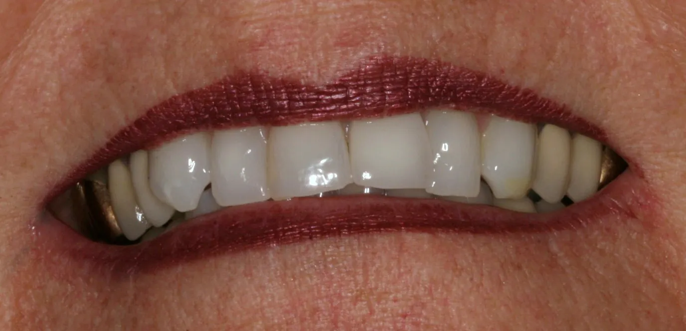 After: straight, clean teeth